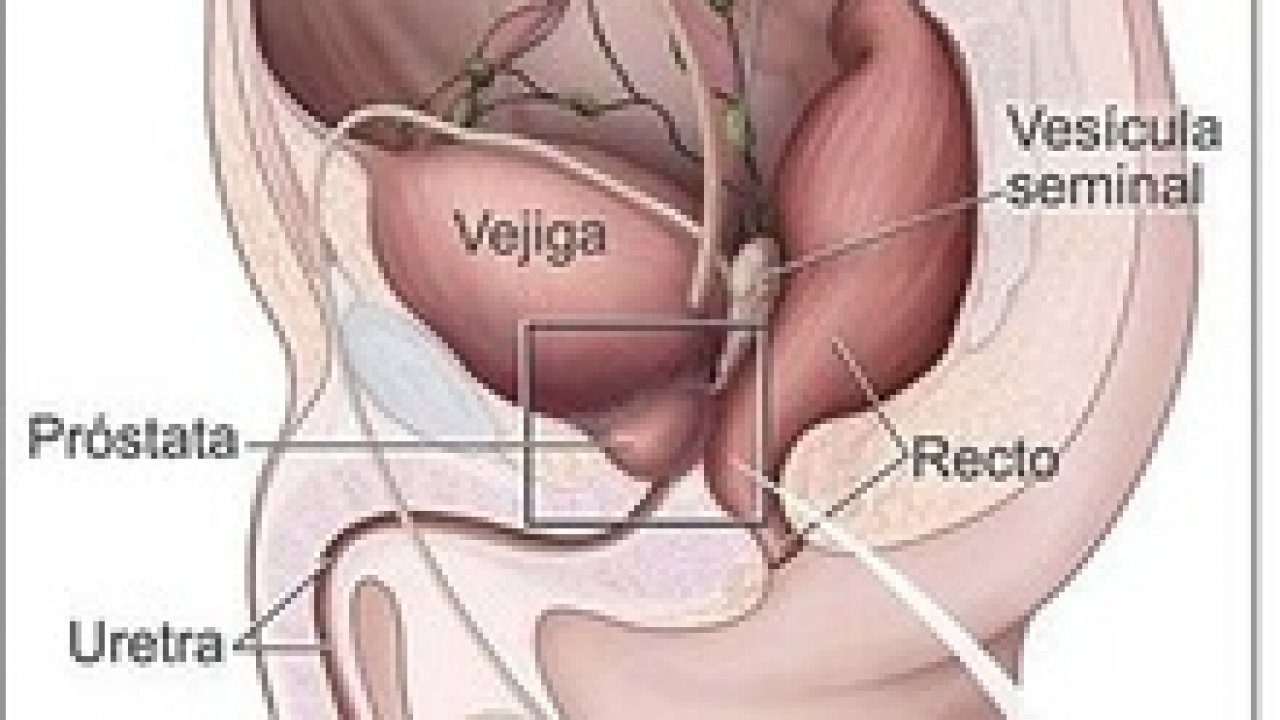 plantas medicinales contra cáncer de próstata