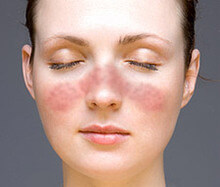 Lupus facial gracias a la wikipedia.org