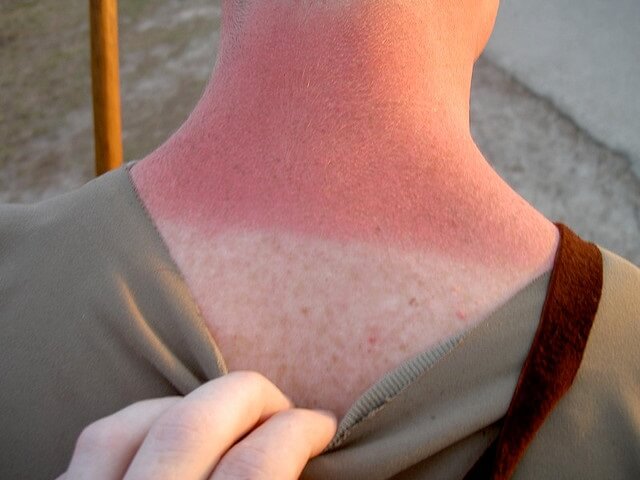 chico con quemadura solar en la espalda