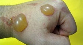 Aromaterapia para tratar las ampollas.