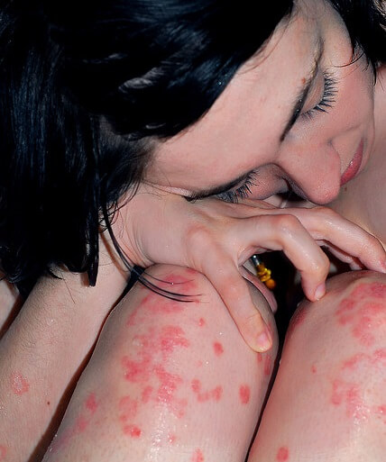 chica con psoriasis en las piernas